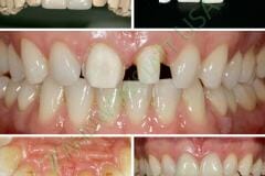 Veneers_Crowns_11_watermark