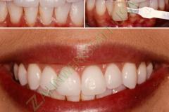 Veneers_Restoration_20_watermark