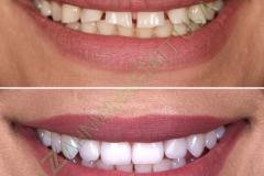 Veneers_21_watermark