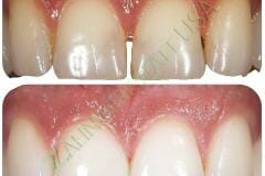 Veneers_6_watermark