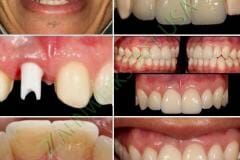 Veneers_Implants_10_watermark